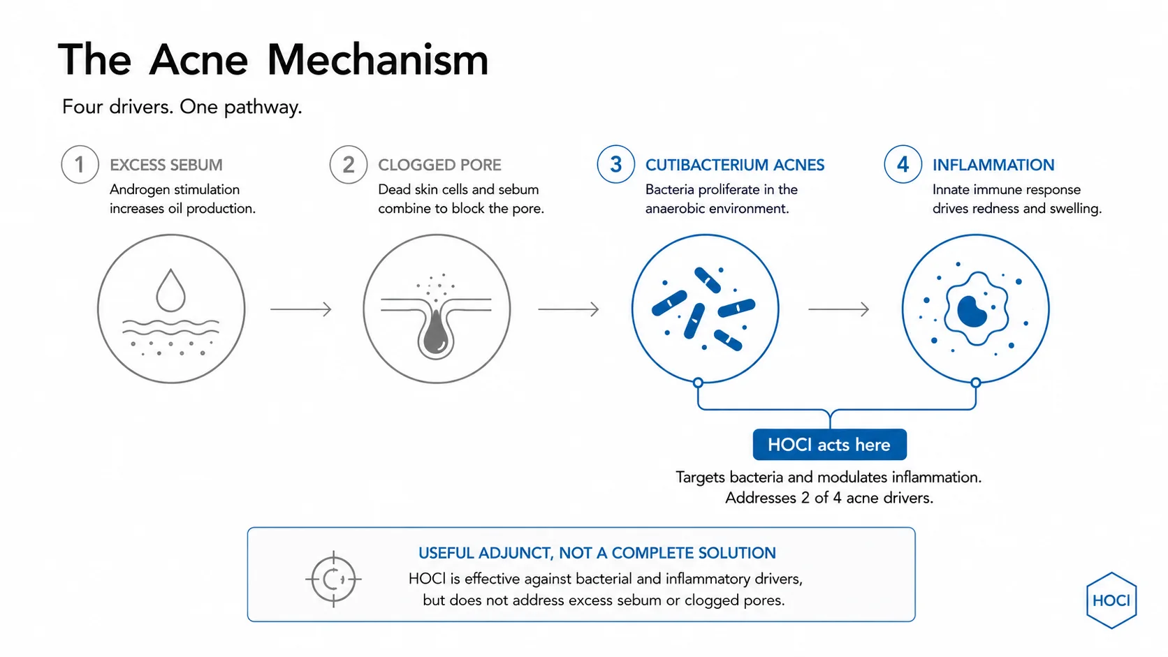 The acne mechanism: four drivers in sequence, excess sebum, clogged pore, Cutibacterium acnes overgrowth and inflammation, with a note that HOCl acts on the bacteria and inflammation steps