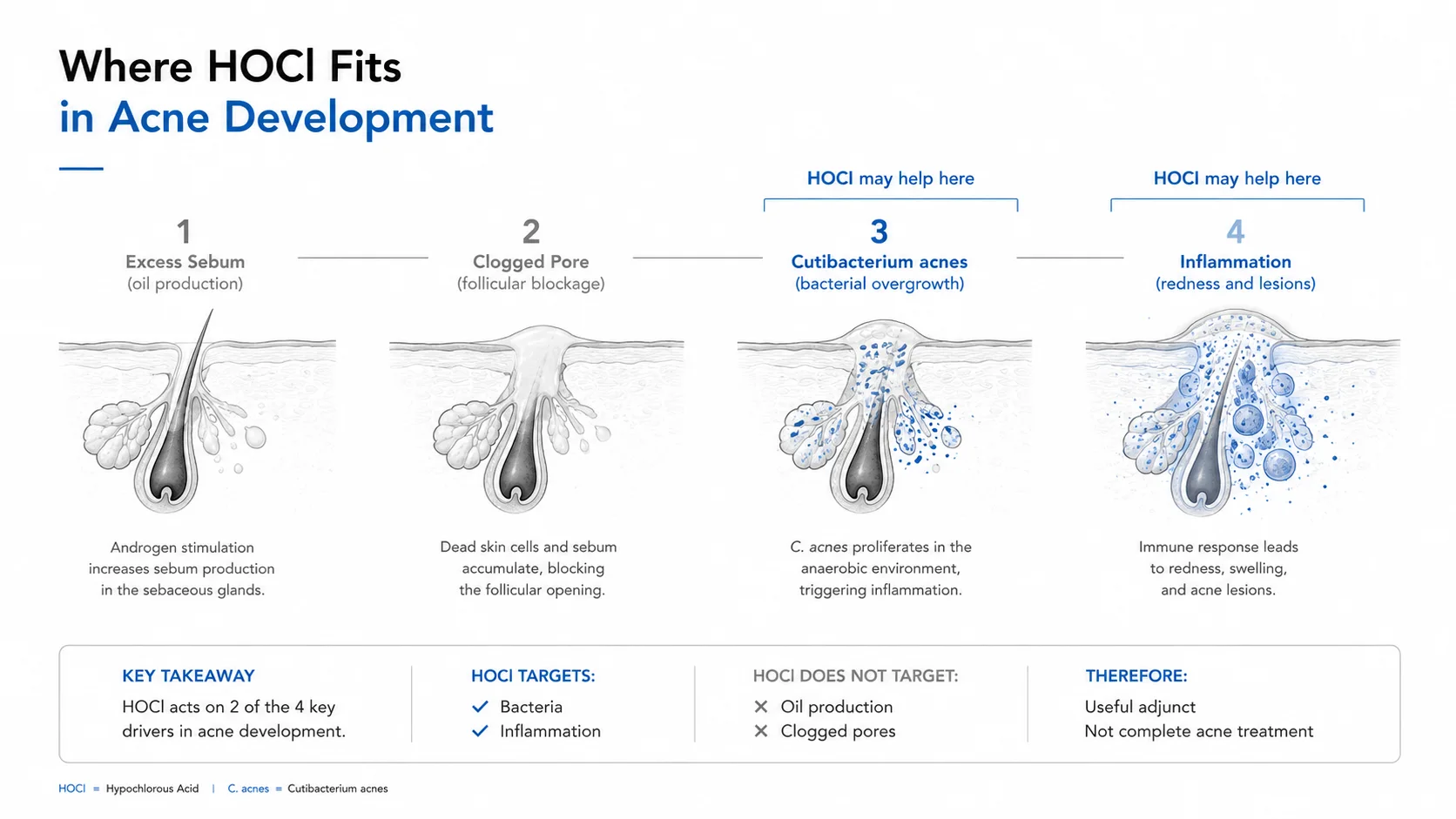 Where HOCl fits in acne development across the four drivers: it may help with C. acnes bacterial overgrowth and inflammation, but does not address excess sebum or clogged pores, making it a useful adjunct rather than a complete acne solution